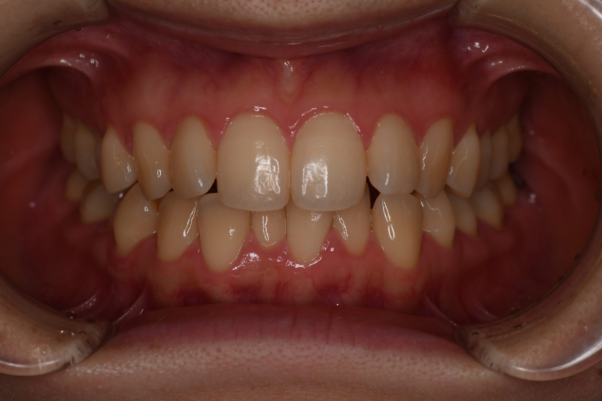 Before