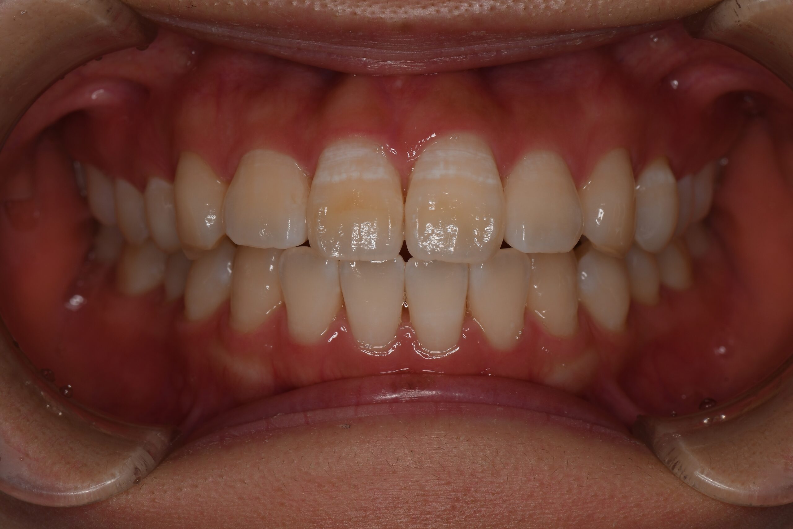 Before