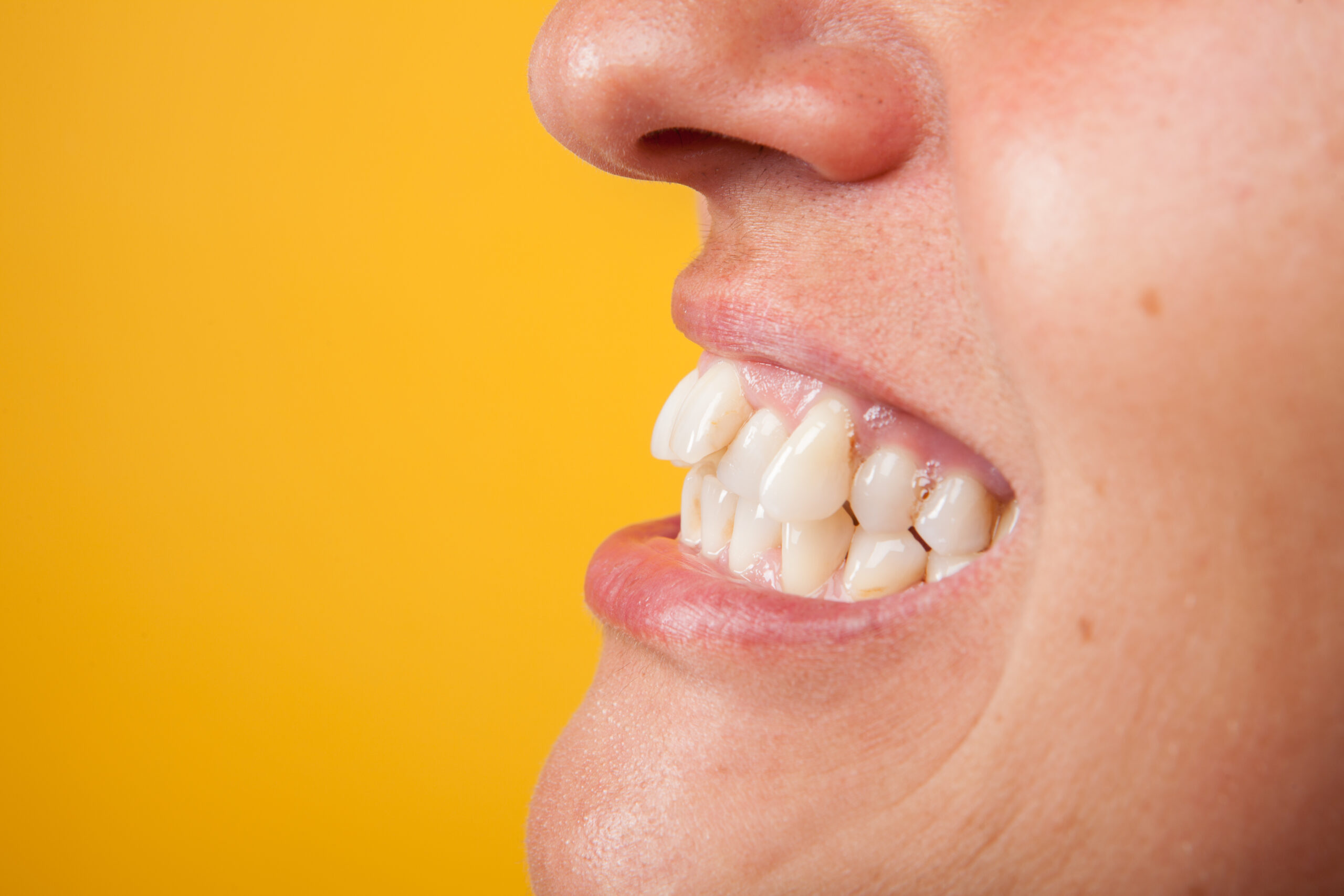 white smile with curvature tooth of young woman on background in studio