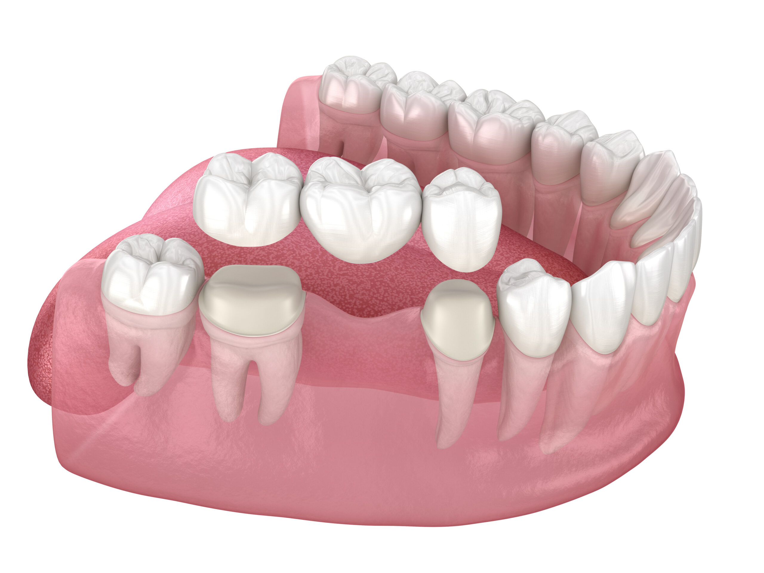 Dental bridge of 3 teeth over molar and premolar. Medically accurate 3D illustration of human teeth treatment