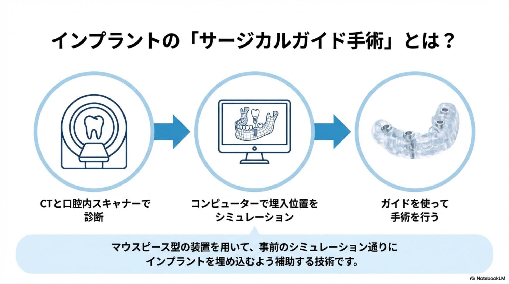 インプラントのサージカルガイド手術とは